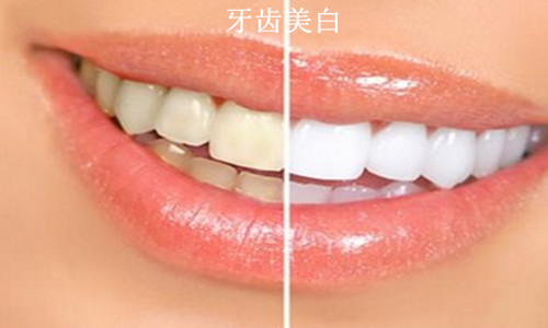牙齿美白效果，兰州牙科医院，兰州惠安齿科