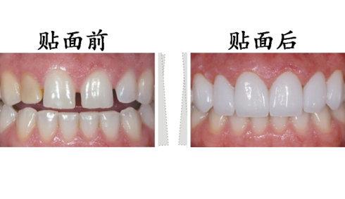 烤瓷牙牙龈变黑了还能用吗，兰州牙科医院，兰州惠安齿科
