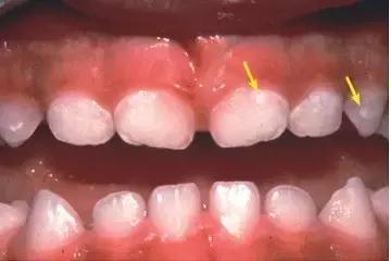 儿童补牙需要多少钱，兰州牙科医院，兰州惠安齿科