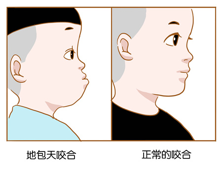 两岁小孩牙齿地包天怎么办，兰州牙科医院，兰州惠安齿科