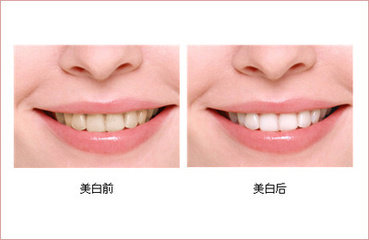 牙齿美白的误区有哪些? 兰州惠安齿科