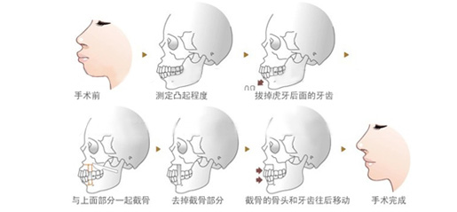 外科手术矫正的过程是怎么样的呢？兰州惠安齿科医生介绍。