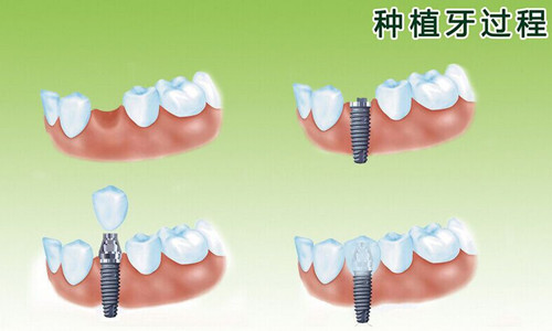 镶牙可以保多久，兰州牙科医院