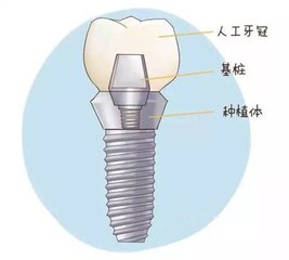 前牙种植用什么材料好