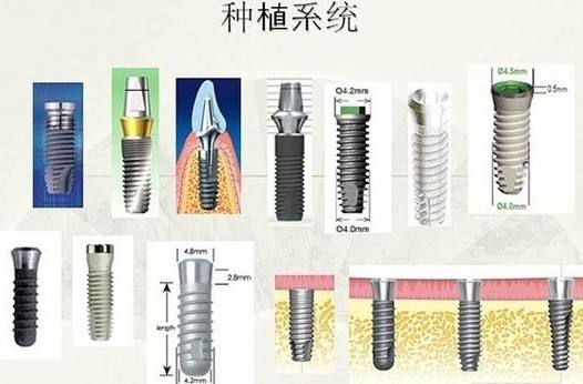 种植牙的常见种类有哪些呢