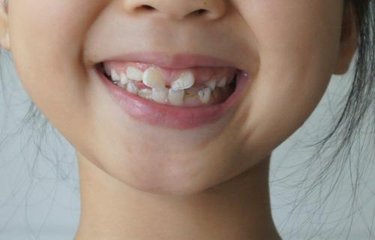 小孩戴牙套一般多少钱，兰州牙科医院，兰州惠安齿科