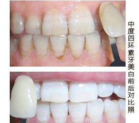 四环素牙怎么办，能洗掉吗