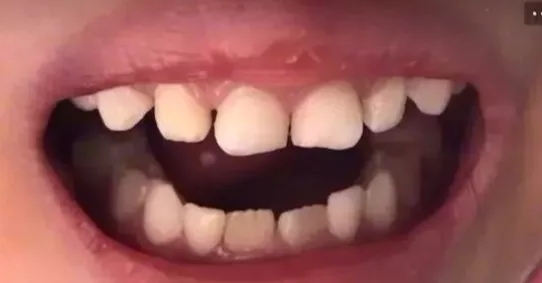 小孩子龅牙怎么办，兰州牙科医院，兰州惠安齿科