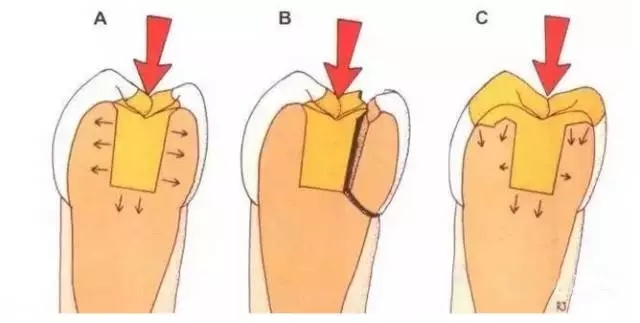 牙齿松动的治疗方法有哪些呢，兰州惠安齿科医生介绍。