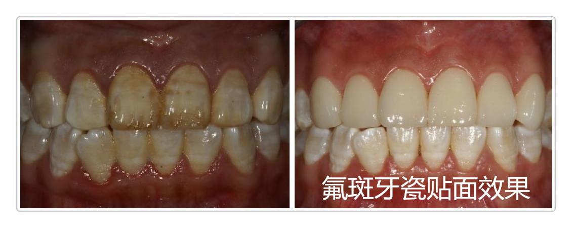 哪种美白方法治疗四环素牙好