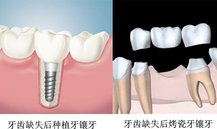 牙齿缺损应该如何修复呢,牙科医院，兰州惠安齿科