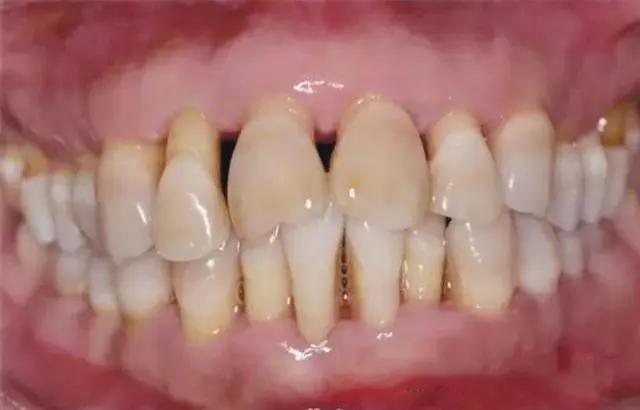 牙齿矫正必须拔牙的情况有哪些