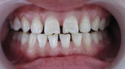 美容冠牙齿矫正效果怎么样
