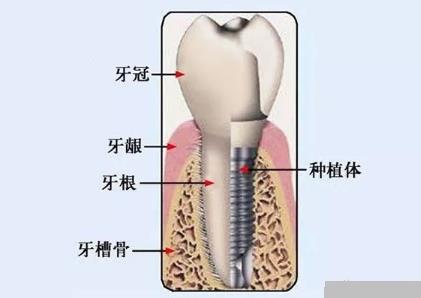 牙齿修复的方法有很多种
