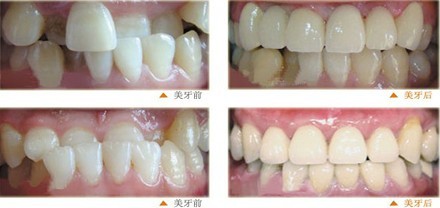 美容冠矫正效果好不好