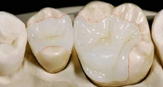 门牙缺失可以用烤瓷牙修复吗，兰州惠安齿科医生介绍