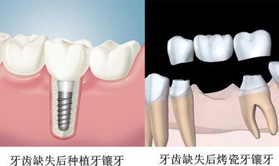 缺失牙不补会怎样呢