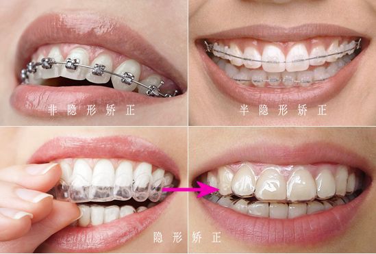 牙齿矫正有年龄限制吗