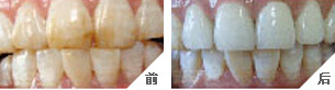 氟斑牙有哪些危害，兰州惠安齿科医生介绍。