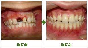 补牙材料该怎样选择