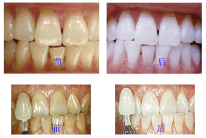牙齿变色是什么导致的呢