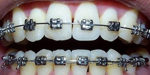 牙齿矫正费用需要多少