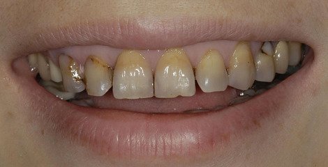 四环素牙应该如何美白呢