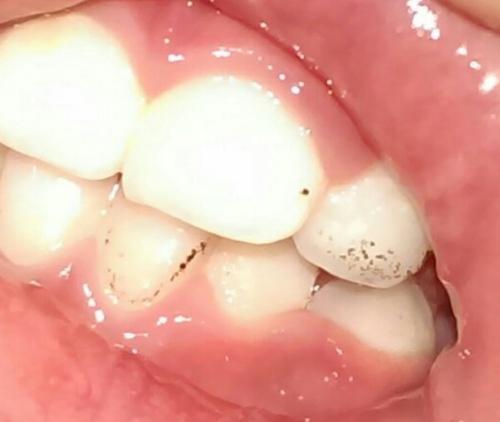成年人蛀牙了补牙要多少钱
