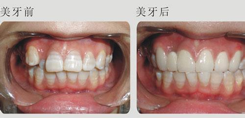 牙齿不整齐可以做瓷贴面吗