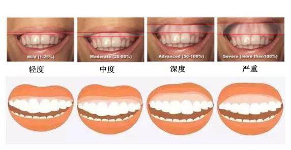 露龈笑能治吗，怎么治疗好