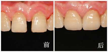 补牙缝要多久才能做好