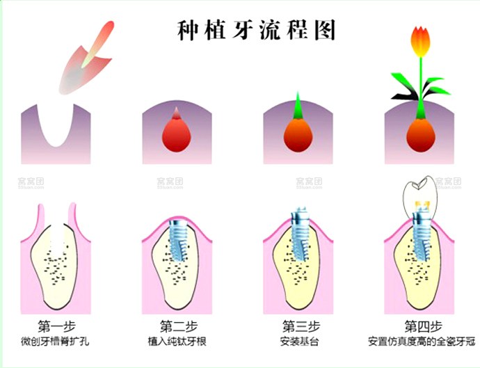 年轻人可以种植牙么吗