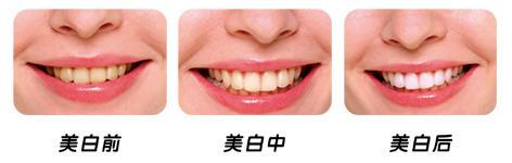 冷光美白有哪些危害