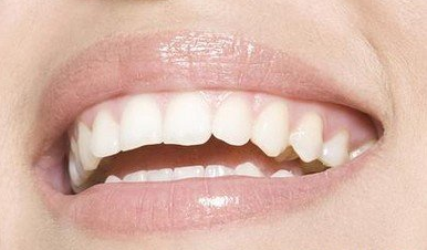 美容冠治疗牙齿后能使用多久