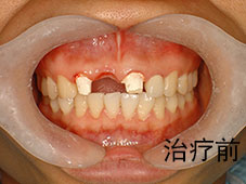 老人两颗大牙掉落，怎么治疗