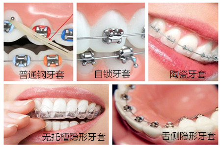 牙齿矫正要准备多少费用
