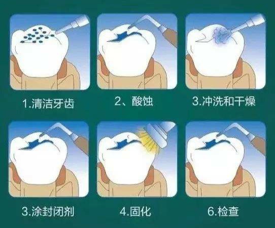 窝沟封闭的示意图