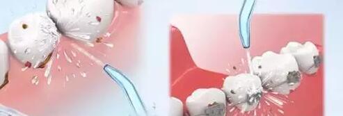 牙结石的防护