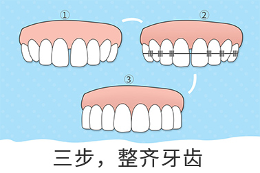 牙齿不齐的危害