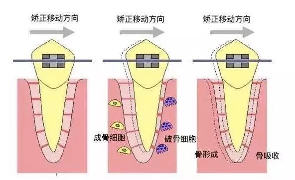 牙周炎