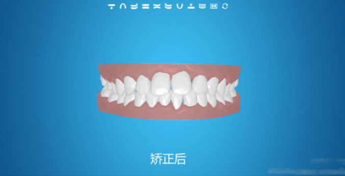 牙齿矫正时间越短越好吗？
