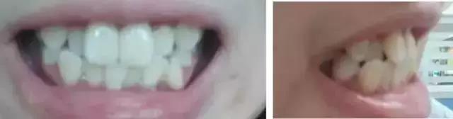 牙齿畸形
