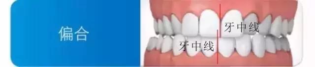 偏颌