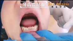 牙齿瓷贴面多少钱
