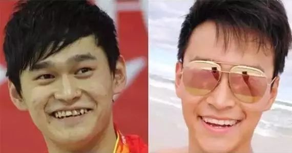 牙齿矫正的前后变化