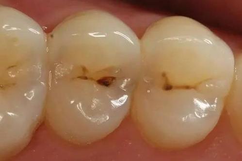 蛀牙怎么止痛？
