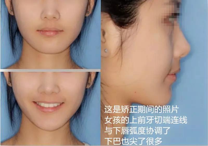 矫正前后的对比