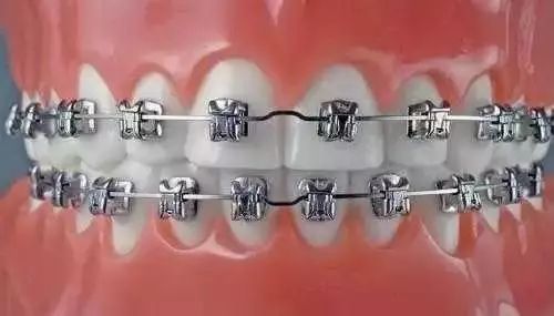 牙齿矫正的材料是怎样分类的？