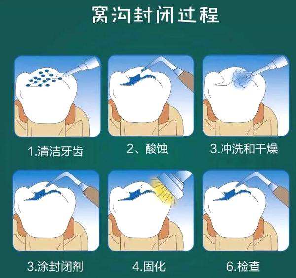 窝沟封闭能预防龋齿吗?