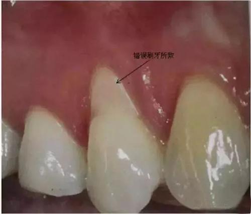 牙龈萎缩怎么治疗？
